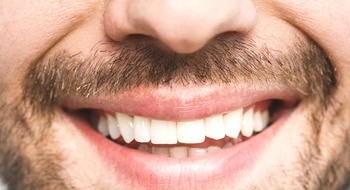 Close up of a man with a chipped front tooth.