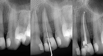 Root canal x-rays