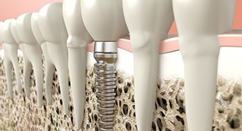 Close-up of dental implant inside the bone