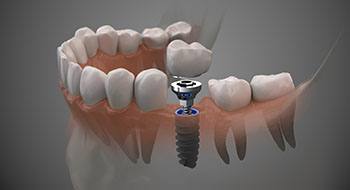 Digital model of implant, abutment, and crown