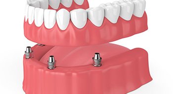 full denture being placed on top of four dental implants in the bottom jaw 