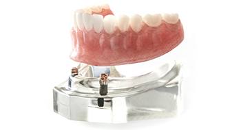 All-on-4 denture being placed on a model of a bottom jaw with dental implants 