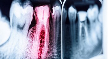 An X-ray highlighting the cost of a root canal in Daytona Beach