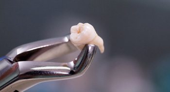 A tooth pulled to avoid the cost of a root canal in Daytona Beach