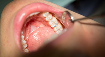 Closeup of teeth examined after restoration