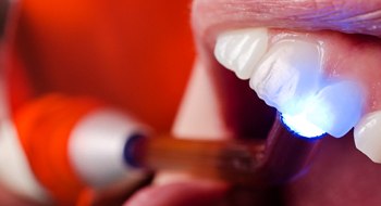 Dental light for cosmetic bonding. 