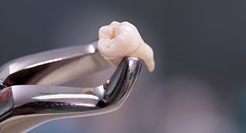 Metal Clasps holding extracted tooth