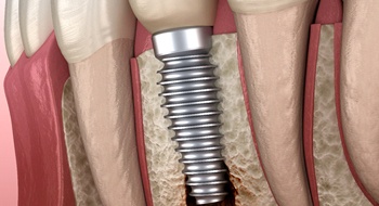 A digital image of a dental implant failure in Daytona Beach