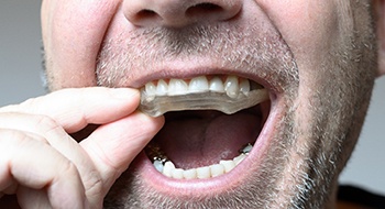 An up-close image of a man inserting a mouthguard to better protect his dental implants in Daytona Beach
