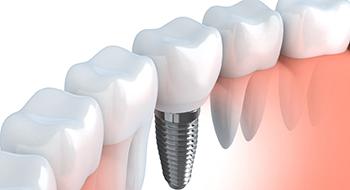 A dental implant inserted into the jaw