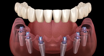A digital image of implant dentures in Daytona Beach on the lower arch