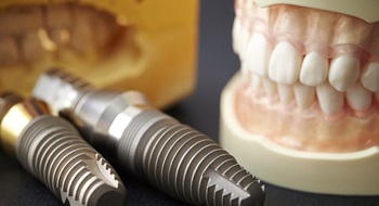 An up-close view of a mouth mold and dental implants in Daytona Beach