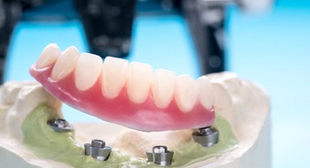 A mouth mold with an implant denture in Daytona Beach is placed on the lower arch