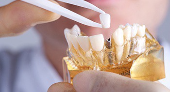 dentist demonstrating dental implants in Daytona Beach 