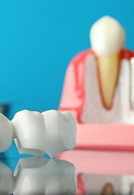 Model dental bridge on reflective surface in front of sample implant