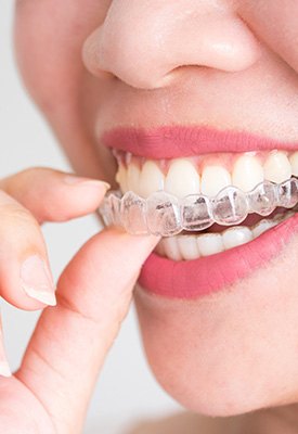 Patient removing Clear Correct aligner from teeth