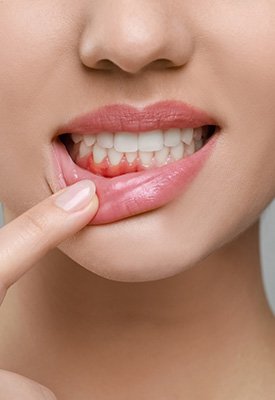 Nose-to-neck view of woman pulling down lip to reveal red gums