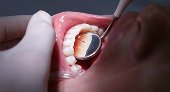 closeup of teeth examined for gum disease