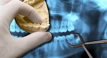 Model of smile and x-ray of wisdom teeth