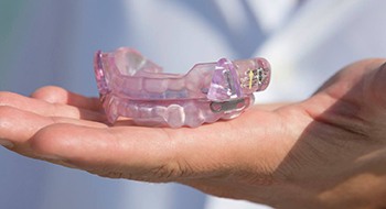 Custom occlusal splints