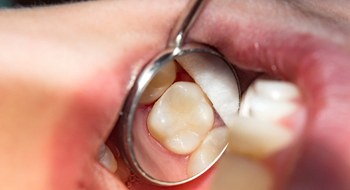 a dental mirror magnifying a tooth-colored filling in Daytona Beach