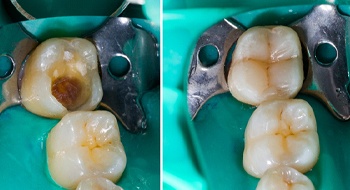 before-and-after cavity after a tooth-colored filling