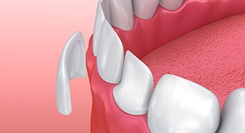 Animation of porcelain veneer placement