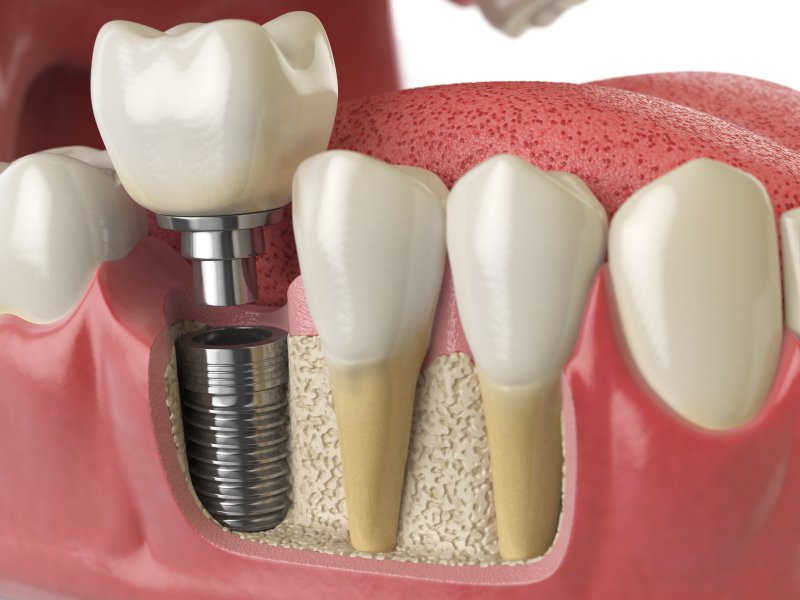 3D diagram of a dental implant