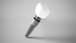 a dental implant against a white background