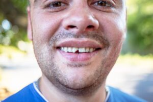 Man with chipped front tooth smiling.